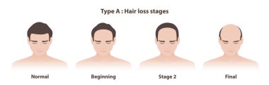 A tipi saç dökülmesi aşamaları erkek modeli kellik vektör illüstrasyonu. Androgenetik alopecinin bilgi aşamaları, saç çizgisi önden arkaya doğru çekilir. Saç bakımı ve sorun konsepti.