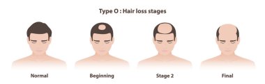 0 kan grubu saç dökülmesi aşamaları, erkeklerinki gibi kellik çizimleri. Androgenetik alopecinin bilgi aşamaları, taç veya başının arkasında yuvarlak, oval kel bir bölge. Saç bakımı ve sorun konsepti.