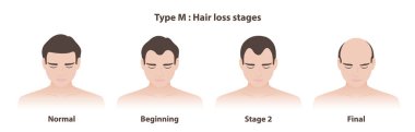 M tipi saç dökülmesi aşamaları erkek modelinde kellik çizimi. Androgenetik alopecinin bilgi aşamaları. Saç çizgisi tapınaklarda geri çekiliyor ve M şeklinde oluyor. Saç bakımı ve sorun konsepti.
