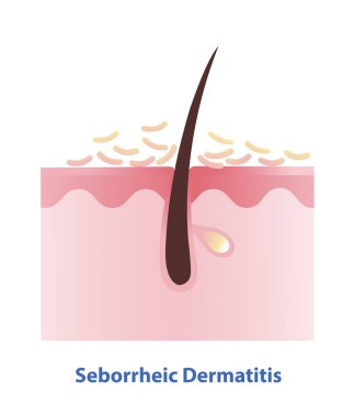 Deri tabakası illüstrasyonunda Seborrheic Dermatitis. Sebderm 'in çapraz kesimi, iltihaplı, yağlı pullu kırmızı bantlar ve cildin yağlı bölgelerinde pullar. Cilt bakımı ve güzellik kavramı.