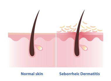 Normal cilt ve Seborrheic Dermatitis illüstrasyonu karşılaştırması. Sebderm 'in çapraz kesimi, iltihaplı, yağlı pullu kırmızı bantlar ve cildinde pullar. Cilt bakımı ve düzensizlik kavramı.
