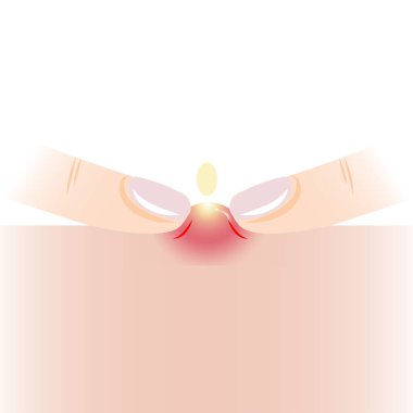 Beyaz arka planda izole edilmiş deri vektörü illüstrasyonunda iki parmağıyla sivilce sıkma bilgisi. Kabarcık, iltihaplı sivilce, sıkma, sivilce. Cilt bakımı ve güzellik kavramı.