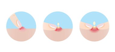 Sivilcelerdeki, sivilcelerdeki, sivilcelerdeki, sivilcelerdeki, parmak izlerindeki ikon seti. Sivilceleri sıkmak iyi değildir, yara ve enfeksiyona neden olabilir. Cilt bakımı ve güzellik kavramı.