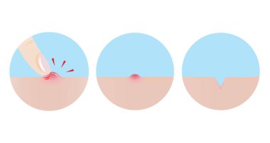 Sivilce ve parmak ikonu buz tutmuş yara izine dönüşüyor. Papule, deride iltihaplı sivilce, sivilce, parmak darbesi ve sivilce yarası. Cilt bakımı ve güzellik kavramı.