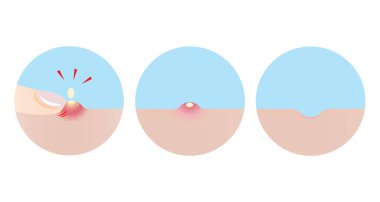 Parmağı olan bir çift sıkılmış sivilce yuvarlanan bir yara izine dönüşüyor. Kabarcık, iltihaplı sivilce, sivilce, sivilce, parmak, sivilce izi. Cilt bakımı ve güzellik kavramı.