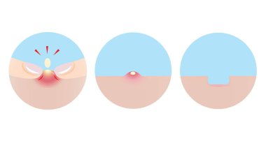 İki parmağıyla sivilce patlatan ikon seti yük vagonundaki yara izlerine dönüşüyor. Kabarcık, deride iltihaplı sivilce, parmaklarıyla sivilce yapan sivilceler sivilce izine dönüşüyor. Cilt bakımı ve güzellik kavramı.