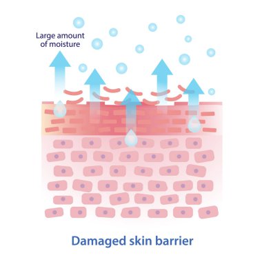 Hasarlı deri bariyerinin durumu. Stratum korneum çöker, nem deri yüzeyinden buharlaşır. Transepidermal su kaybı miktarı, TEWL büyük. Kuru, kırmızı, pürüzlü cilt.