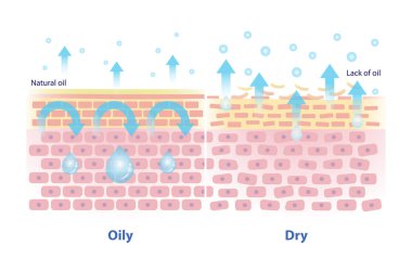 Yağlı ve kuru deri vektör çizimi mekanizması. Deri katmanındaki doğal yağ karşılaştırması tıkanık, daha az transepidermal su kaybı gibi davranır. Ve ciltteki yağ eksikliği daha çok TEWL 'e neden oluyor.