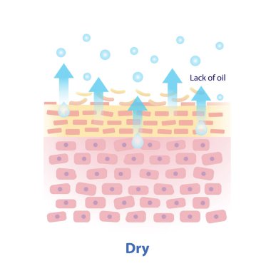 Beyaz arkaplanda izole edilmiş kuru deri vektör çizimi mekanizması. Deri tabakasında doğal yağ eksikliği daha fazla transepidermal su kaybına neden olur. Cilt bakımı ve güzellik kavramı.