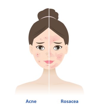 Kadınların yüzlerindeki sivilce ve rosacea karşılaştırması. Farklı sivilceler, sadece patlağın etrafındaki kızarıklıklar. Rosacea, yanaklarda kızarıklığa neden olur, burun, çene, alın, bazen sivilceler..
