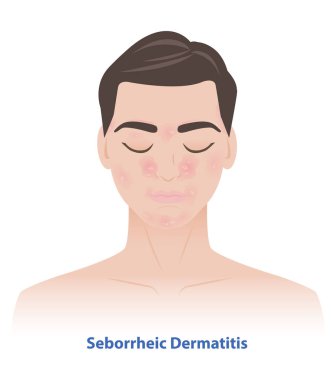 Seborrheic Dermatitis insan yüzü vektör illüstrasyonunda. Sebderm, iltihaplı deri, pullu yamalar, yüzün yağlı bölgelerinde, kaşların üzerinde, burun taraflarında, sakal bölgesinde, kulaklarda, göz kapaklarında....