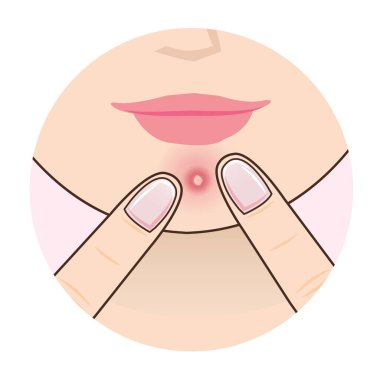 Kadın yüz vektör illüstrasyonunda sivilce. Kadın iki parmağıyla sivilce, sivilce ve iltihaplı bir şekilde çenesini sıkıyor. Yara izine neden olabilir. Cilt bakımı ve güzellik kavramı.