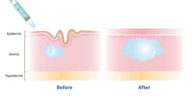 Beyaz arka planda deri vektör illüstrasyonu altında doldurucu enjeksiyonundan önce ve sonra. Hyaluronik asit, çizgileri ve kırışıklıkları düzeltmek için enjekte edilen deri dolgusudur. Tıbbi ve güzellik konsepti.