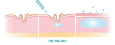 Deri vektör illüstrasyonu altında doldurma işlemi. Cilt dolgusu, yüz yaşlanmasının tedavisi için deri tabakasına iğneyle enjekte edilmiş. Tıbbi ve güzellik konsepti.