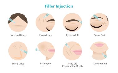 Kadın yüz vektör simgesine deri doldurucu enjeksiyonu. Doldurucu enjeksiyon alanlarının ikon kümesi Alın, Tavşan, kaş çizgileri, Karga ayakları, kaş kaldırma, kare çene kaldırma, Gülümseme kaldırma ve Çukur Çene.