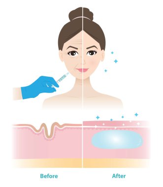 Kadının yüzüne deri doldurma enjeksiyonunun öncesi ve sonrasının karşılaştırması. Çizgileri ve kırışıklıkları düzeltmek için cilt ve dolgu maddesinin çapraz kesiti. Tıbbi ve güzellik konsepti.