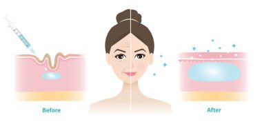 Kadın yüz vektör illüstrasyonunda deri altına yapılan dolgu öncesi ve sonrasının karşılaştırması. Çizgileri ve kırışıklıkları düzeltmek için deri dolgusunun çapraz kesitini enjekte ettim. Tıbbi ve güzellik konsepti.