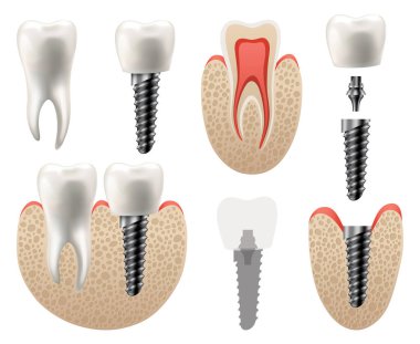 Diş implantı yapısı. Tıbbi eğitici bilgi afişi. Diş implantı, dişçiliğin gerçekçi vektör tasarımı. İmplant vida, sağlık hizmeti, diş hekimi ve diş hekimi tedavisi.