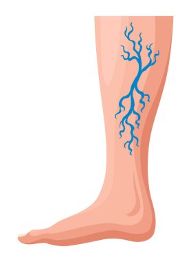 Varis gelişimi aşamaları ya da türleri. Tıbbi poster ya da hastalık bilgisi. Hastalıklı bacakların görüntüsü. Düz biçimli vektör illüstrasyonu.