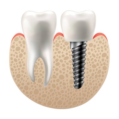 Diş implantı yapısı. Tıbbi eğitici bilgi afişi. Diş implantı, dişçiliğin gerçekçi vektör tasarımı. İmplant vida, sağlık hizmeti, diş hekimi ve diş hekimi tedavisi.