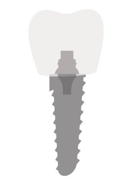 Diş implantı yapısı. Tıbbi eğitici bilgi afişi. Diş implantı, dişçiliğin gerçekçi vektör tasarımı. İmplant vida, sağlık hizmeti, diş hekimi ve diş hekimi tedavisi.