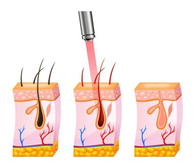 Deride yoğunlaştırılmış ışık demeti olan lazer tüy çıkarma prosedürü. Deri katmanları, lazer vücut kıllarını etkiler. Kozmetoloji ya da cilt bakımı için yüz kılı temizleme ikonu. Tıp bilimi kavramı.