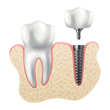 Diş implantı yapısı. Tıbbi eğitici bilgi afişi. Diş implantı, dişçiliğin gerçekçi vektör tasarımı. İmplant vida, sağlık hizmeti, diş hekimi ve diş hekimi tedavisi.
