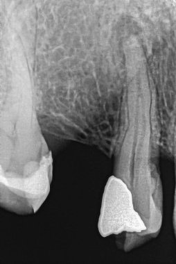 Üst azı dişinin Retro-alveolar röntgeni ve amalgam taç restorasyonlu azı dişi. Azı dişi radyolürik apandisit iltihabı gösteriyor. Kök kanallarının anatomisi birleşen bir çatallaşma gösteriyor.
