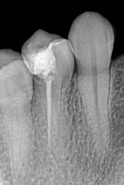 Retro-alveolar röntgen iki azı dişi ve bir alt dişi gösteriyor. Bir azı dişi radyoaktif guta-percha kök kanal tıkanıklığı ve birleşik taç restorasyonu ile endodontik tedaviden geçmiş..