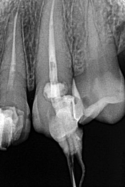 Üst çene kemiğinin Retro-alveolar röntgeni servikal taç üzerinde radyoaktif bileşik yenileme ve kök kanalına yerleştirilmiş bir gutta-percha ile pulpektomi endodontik tedavi gösteriyor..