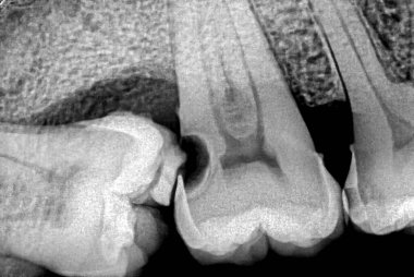 Diş retro-alveolar röntgen röntgenine göre alt yirmilik dişleri patlamamış, ikinci azı dişine baskı yapmış ve boyunda bir boşluk oluşmuş.