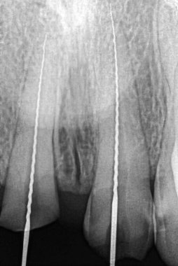 Endodontik tedavi sırasında pulpektomi uygulanan iki üst çene kemiğinin peroperatif retro-alveolar röntgeni ve kök kanallarına yerleştirilmiş radyoaktif metal dosyalar..