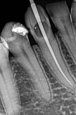 Radyoaktif geçici dolgusu olan çürümüş bir çene azı dişinin diş retro-alveolar x-ışını kontrolü ve endodontik tedavisi gören bir köpek dişi. Kök kanalı gutta-percha malzemesiyle dolu.