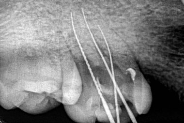 Şiddetli çürümüş bir kaplama ve pulpektomi geçiren maksiller azı dişinin Retro-alveolar röntgeni. Tedavi prosedürü için kök kanallarına üç metalik endodontik dosya ve reamer yerleştirilmiştir.