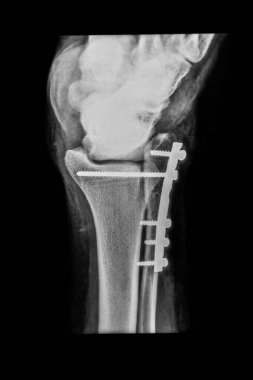 Radyal stiloid vidalarla, arka kol kemiğindeki distal kırığı sabitlemek için kullanılan volar kilit plakasının röntgeni (Colles 'un kırığı). Önceden belirlenmiş periartiküler donanım kemik hizalaması 