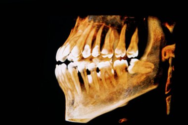 Dişçi 3d renkli röntgen x-ışını konebeam taraması yan görünümü, ikinci azı dişine baskı yaparak zarar gören alt yirmilik dişini gösteriyor. Bu da boşluğun geliştiği bir temas noktası oluşturuyor..