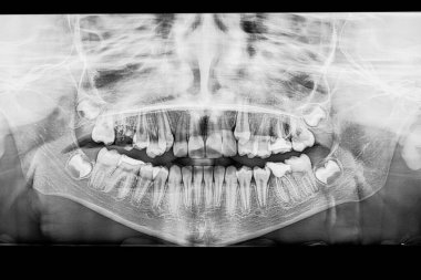 Dişlerdeki panoramik röntgende çarpık dişler, çürümüş azı dişleri endodontikle tedavi edilmiş. Radyografta diş ve yirmilik dişlerin patlamadan önceki ilk tomurcuk aşamasında oluştuğu görülüyor..