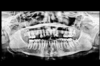Düşük kalitede diş röntgeni, birden fazla diş, periodontal hastalık ya da periodontit olduğunu gösteriyor, ve ciddi derecede çürümüş taç, geriye kalan tek kök alveol kemiğine yerleşmiş.