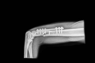Ekstraartiküler eğik humeral kırığın iç saplantısını gösteren ameliyat sonrası radyografın yan görüntüsü. Bir kilit levhası, iki gecikme vidası ve iki kilit vida parçayı stabilize eder..