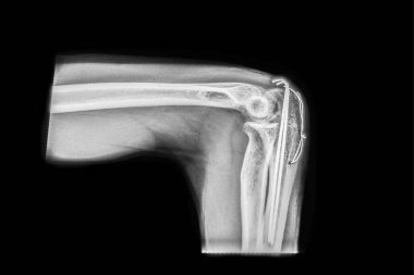 Dirseğin yan radyografında kolekranon kırığı cerrahi olarak sabitlenmiş. İç fiksasyon için transcortical yerleştirme tekniği kullanan raptiyeler ve gerilim bandı kabloları (TBW).