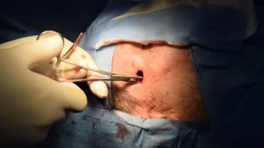 Bir şakaktaki ameliyata yakından bakıldığında cerrah steril bir ameliyathanede, kavisli bir hemostat kıskacı ya da doku tutacağı ile ezilmiş hücre kanseri dokusu tutar..