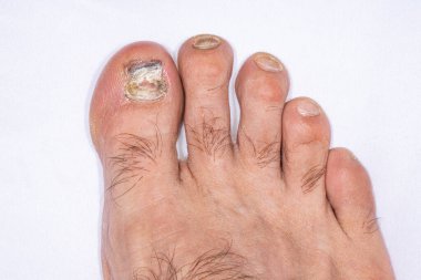 Sağ ayağı mantar mantarı kalınlaşmış, rengi değişmiş ve başparmağı ve ikinci parmağı yırtık pırtık. Beyaz arka planda uzun tırnaklar ve parmak kılları. Parlak ikiz makro ışıklı makro fotoğraf.