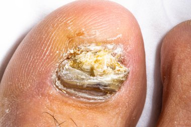 Sağ ayak tırnağı mantarı kalınlaşmış, rengi solmuş ve ayak başparmağında yırtık pırtık. Beyaz arka planda ayak parmağı kılları. Parlak ikiz makro ışıklı makro fotoğraf.