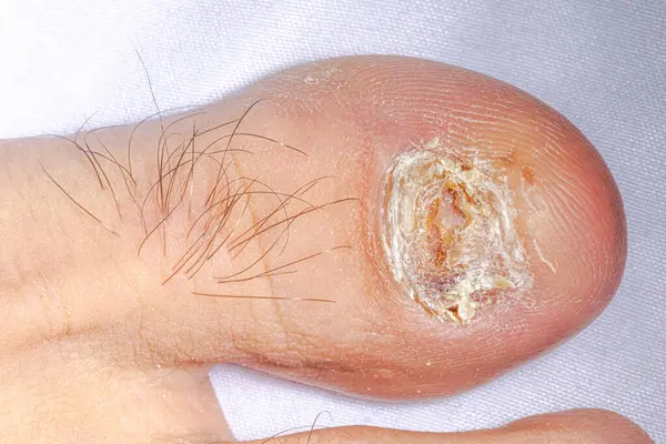 Sağ ayak tırnağı mantarı kalınlaşmış, rengi solmuş ve ayak başparmağında yırtık pırtık. Beyaz arka planda ayak parmağı kılları. Parlak ikiz makro ışıklı makro fotoğraf.