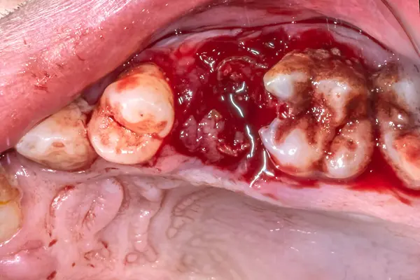 Hastanın üst çene kemiğinin, diş çürüklerini, ağız hijyeninin zayıf olduğunu cerrahi epilasyon bölgesinden sonra kanlı bir alveol soketini ve kalan azıdişi kökünü gösteren bölümünün, tam altında..