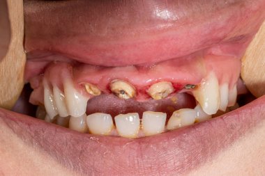 Diş tıkanıklığındaki çürümüş kesici dişler, kökler ve iltihaplı diş eti. Yanaklar ve dudaklar tahta dil bastırıcılarla çekilir. Arka maksilla çıkarılabilir kısmi protez