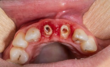 Kanlı sakızda kalan kökler, damak çene kemeri ve açık ağızda kalan çürük merkezi kesik dişler ve dil bastırıcı ile çekilen dudaklar..