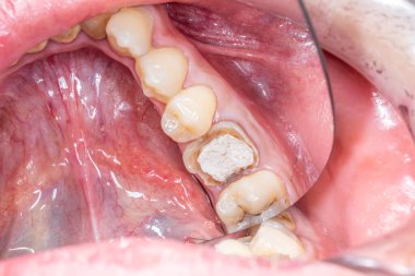 Çürümüş azı dişi kaplamalı, ayna görüntüsünün hemen üstünde. Kök kanallarını korumak için geçici beyaz çimento ile mühürlenmiş kalan yapı tamamen tahrip edilmiş ve hasar görmüş.