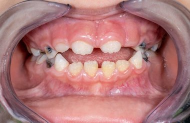 Genç bir çocuğun diş kemerlerinin ön görüntüsü, ısıran tıkanıklık, dudaklar ve yanaklar plastik bir retraktörle geri çekilmiş, dişleri çürümüş siyah köpek dişleri ve azı dişlerinde çürümüş dişleri gösteriyor..