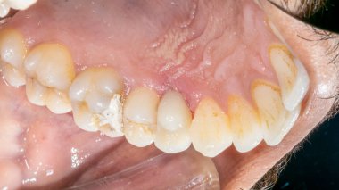 Intraoral buccal view of a dentistry patient case. Maxillary arch showing first premolar restored with a prosthodontic crown and a molar decay cavity filled with a temporary white cement restoration.
